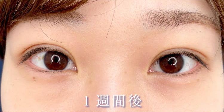 クイックシンデレラのバレない腫れない秘密3